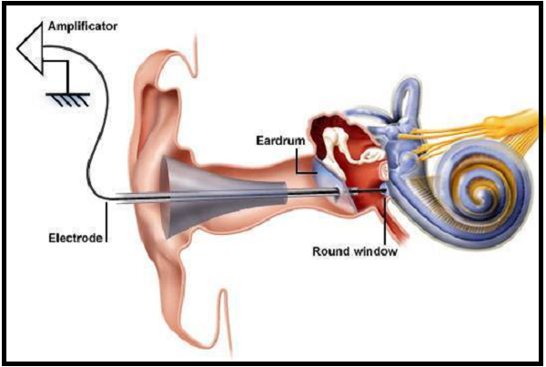 Electrocochleography