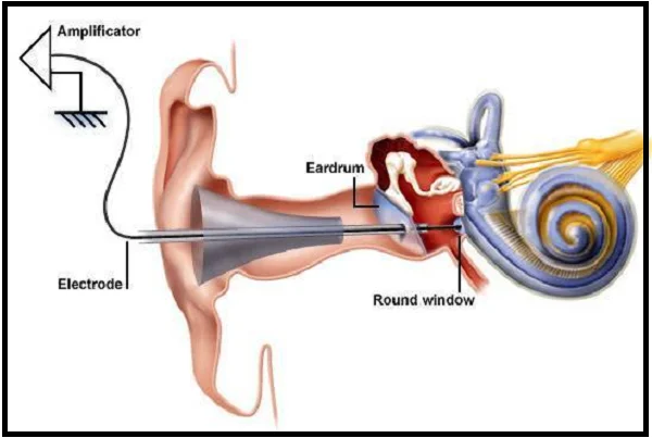 Electrocochleography